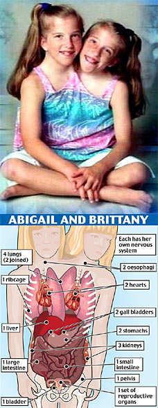 Abigail and Brittany Hensel. Image use for News Reporting by True Strange News. Contact for attribution or removal. https://newsi8.com/wp-content/uploads/2008/04/henseltwins3112_228x589.jpg