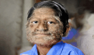 Werewolf Boy Seeks for Cure to Rare Condition