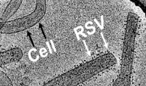 Comparing Respiratory Syncytial Virus (RSV) to Particle Aluminumosis